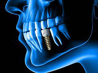 implantate